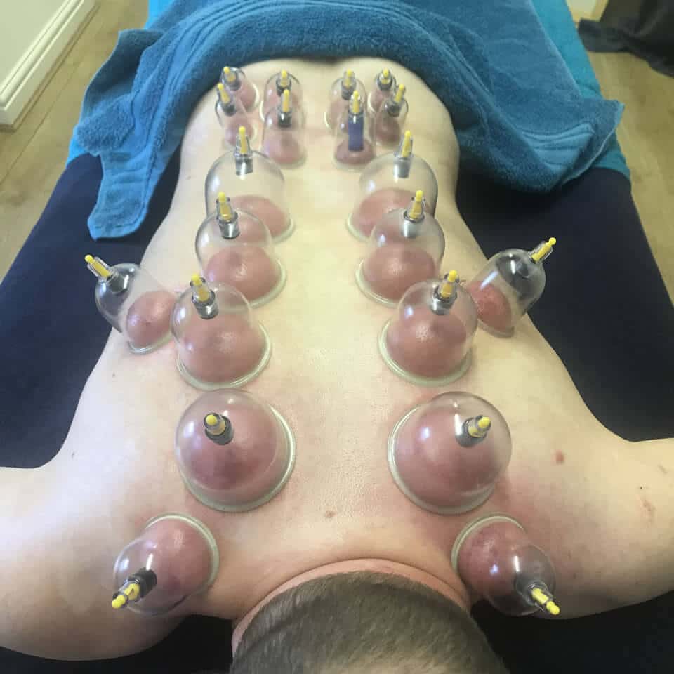 Dry cupping 01 Dry cupping 01