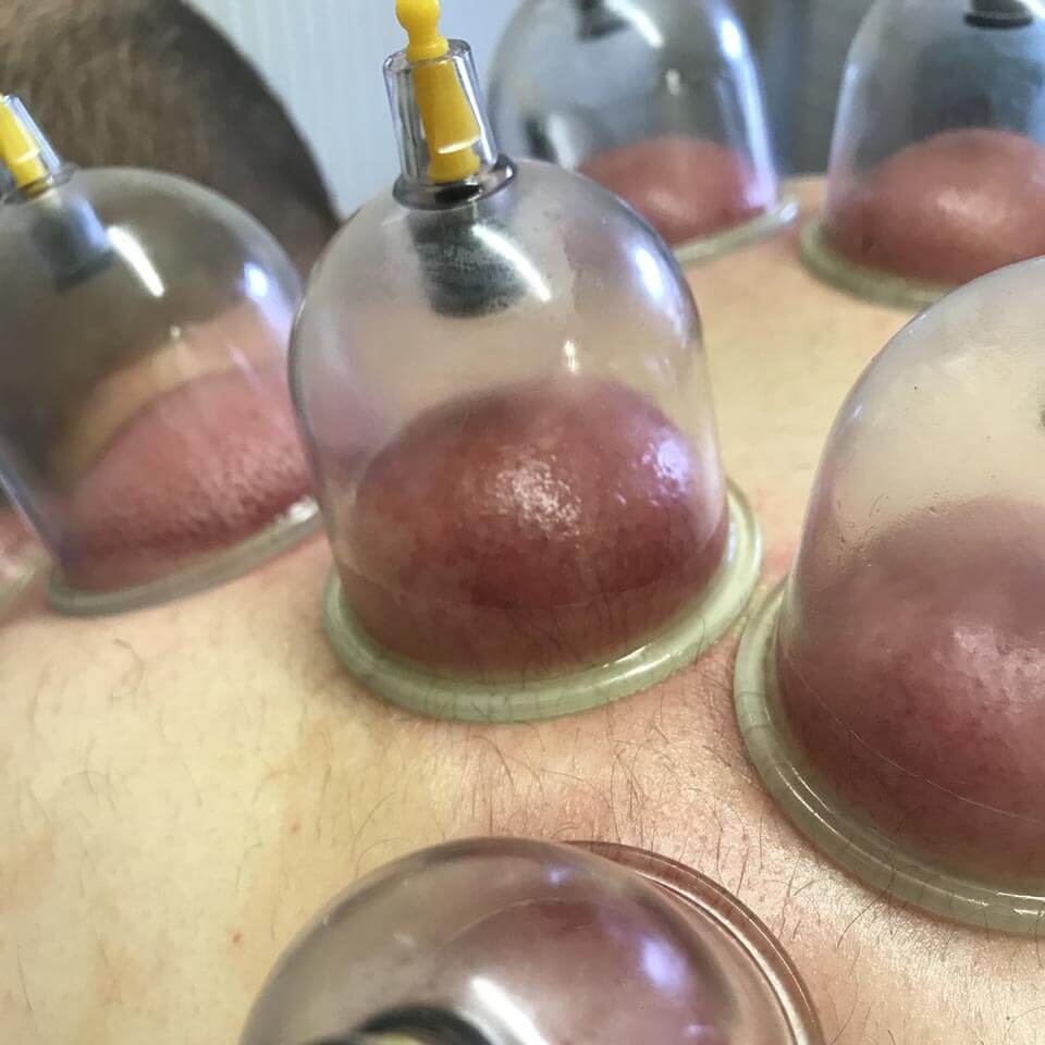 Dry cupping 02 Dry cupping 02