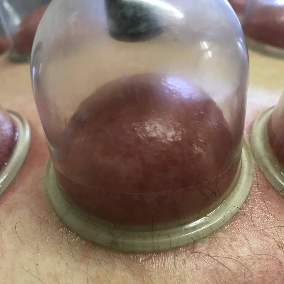 Dry cupping 03 Dry cupping 03