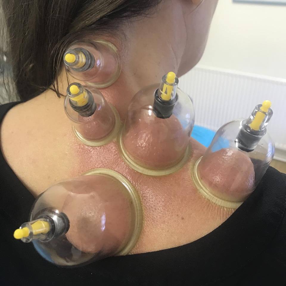 Dry cupping 04 Dry cupping 04