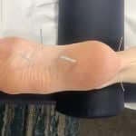 Dry needling