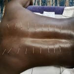 Dry needling new
