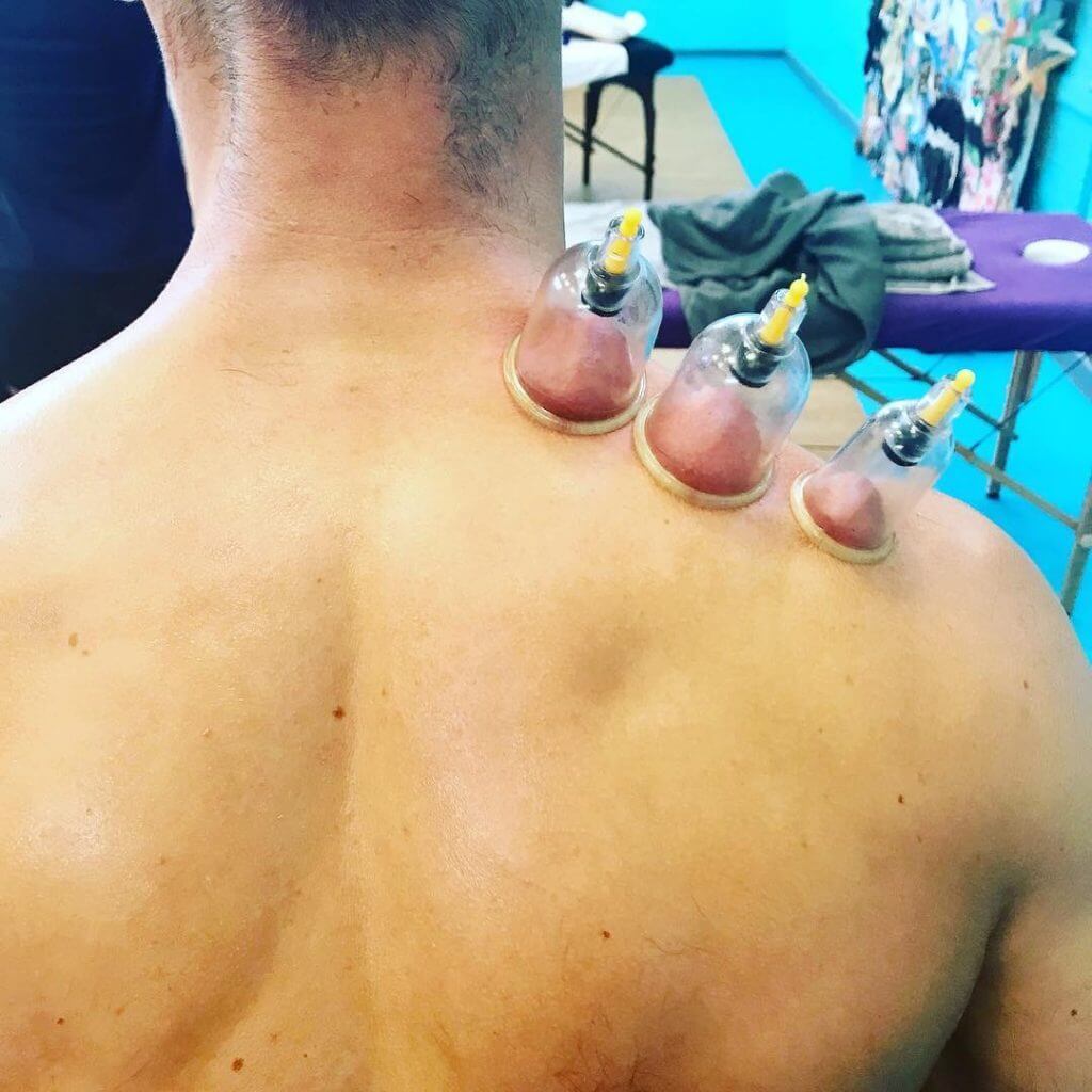 shoulder dry cupping shoulder dry cupping